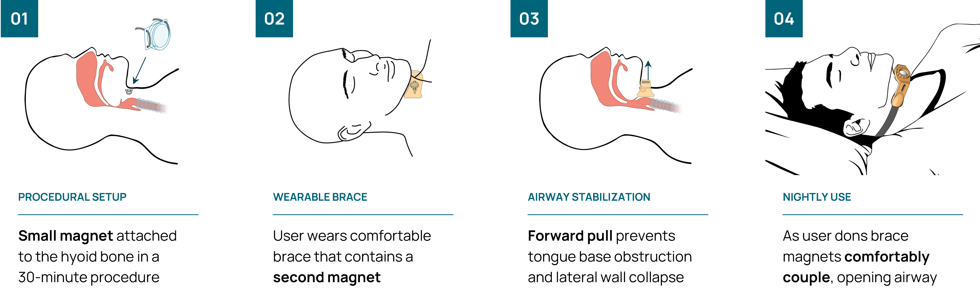 4-step diagram of Corsomed setup, wearable, stabilization, and nightly use